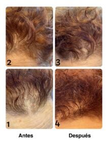 Tratamiento anticaída capilar TR10 Meraki peluqueria Cocentaina
